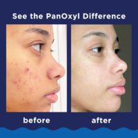 PanOxyl Acne Foaming Wash Benzoyl Peroxide 10% Maximum Strength Antimicrobial, 5.5 Oz - Image 5